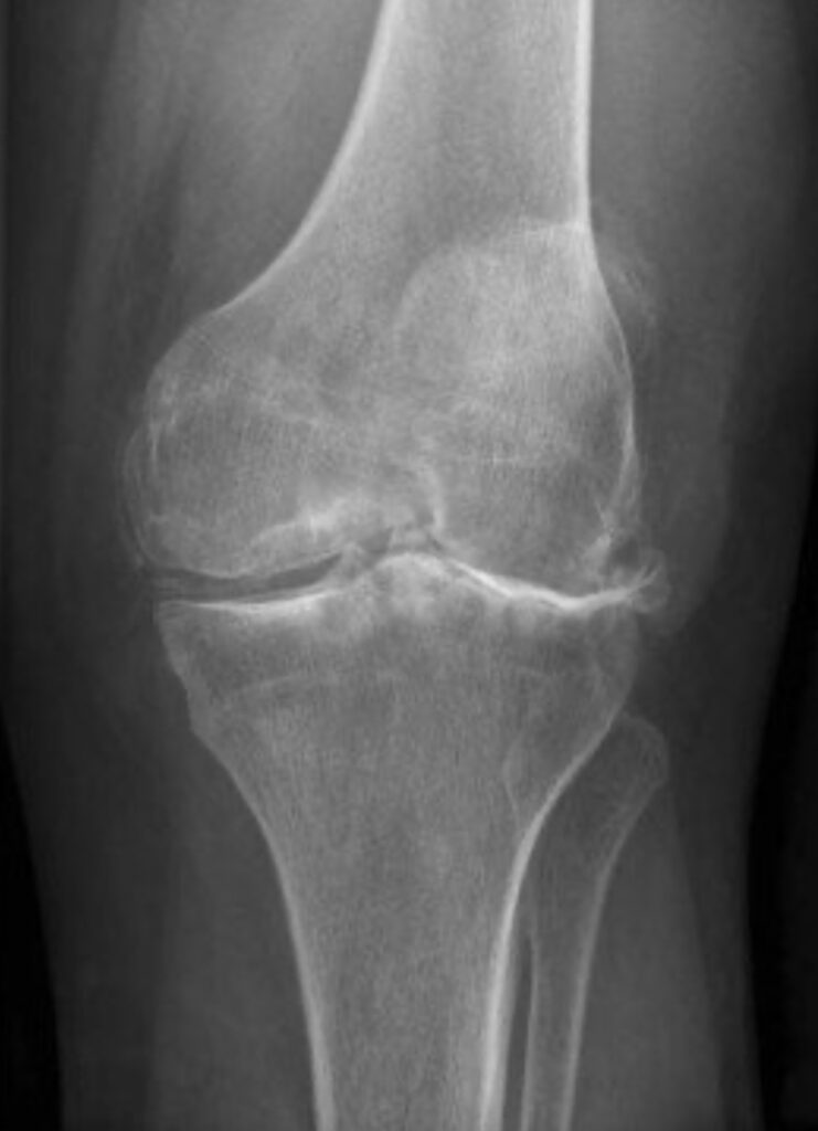 an xray of a left knee showing signs of osteoarthritis